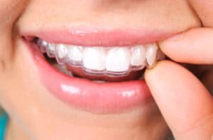 You can remove your aligners to eat and brush your teeth with Invisalign in Bonita Springs. 