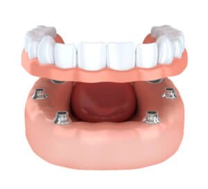 How many teeth do you need replaced by dental implants in Bonita Springs?
