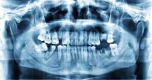 x-ray with missing teeth