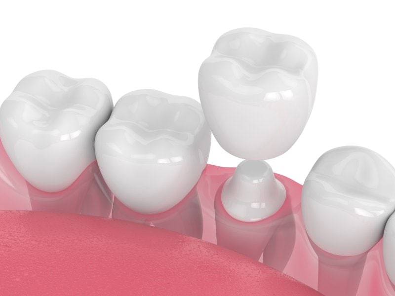 A 3D generated model of a dental crown being placed